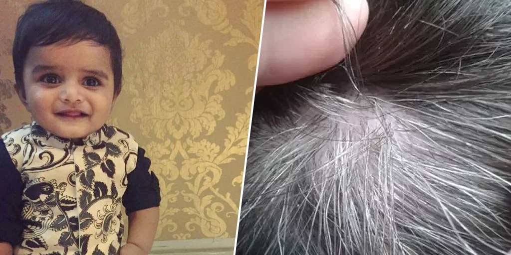 grey hair in kids