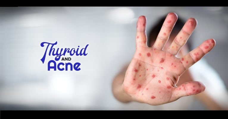 Hypothyroidism Cause Acne