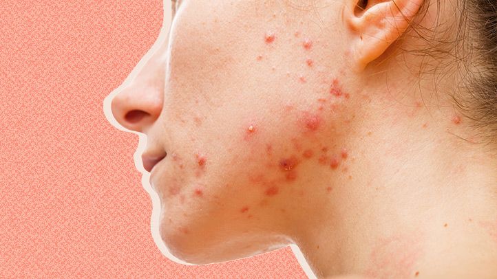 dry skin acne
