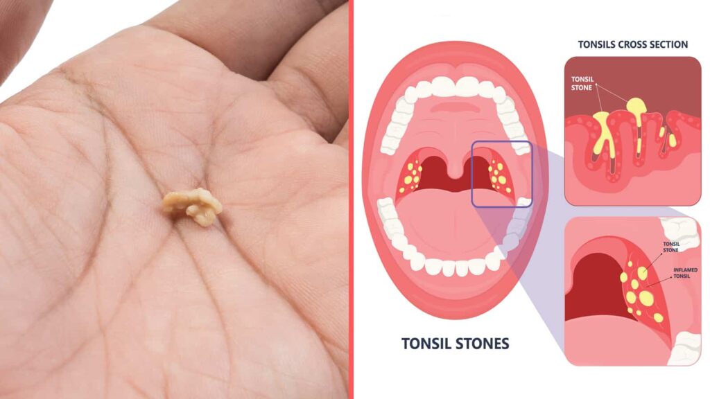 Picture of Tonsil Stones