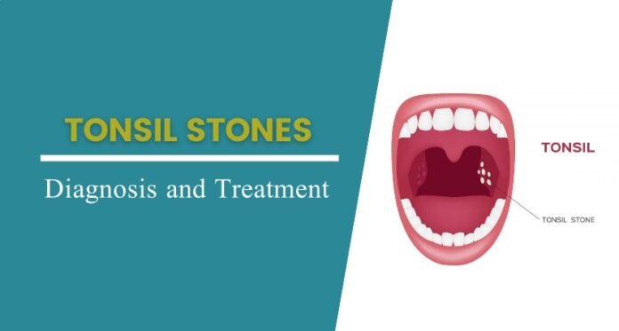 Tonsil Stones: Causes, Symptoms, And Treatment | Behindeye.com