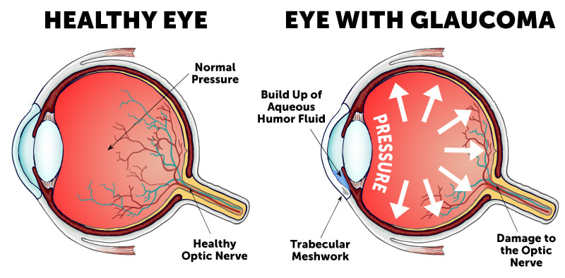 Pressure Behind Eye glaucoma