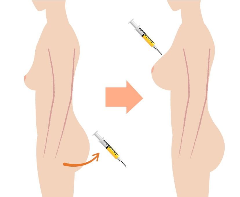 Fat Transfer Breast Augmentation