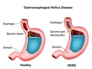 How Long Does Indigestion Last? - Behindeye.com