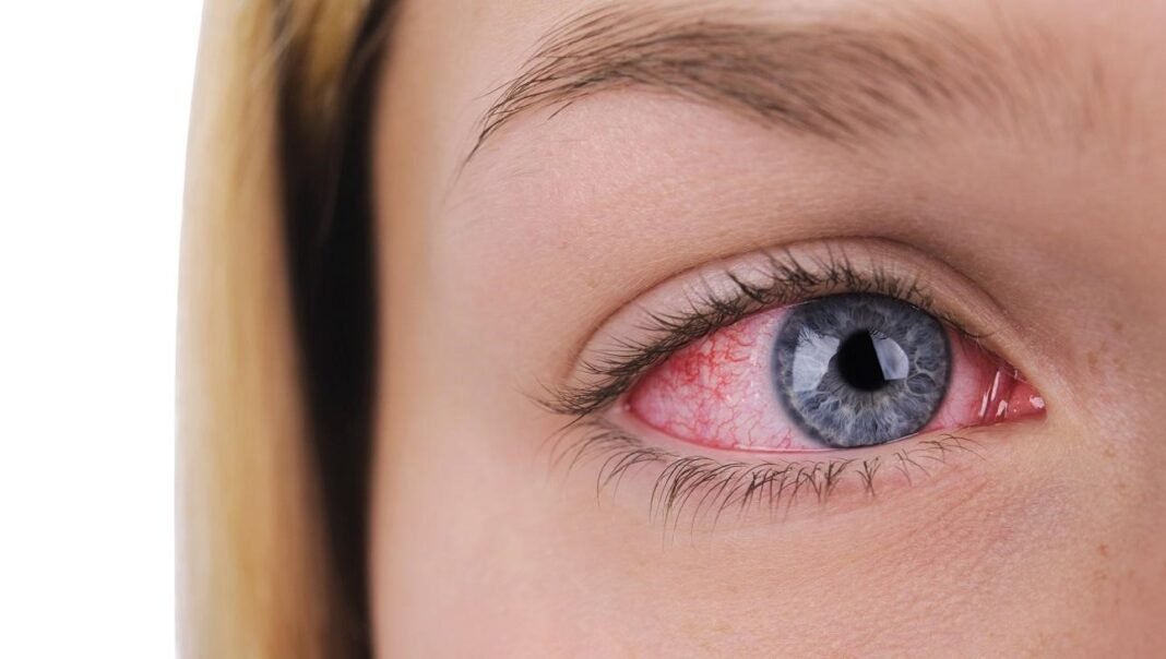 Do Edibles Make Your Eyes Red?